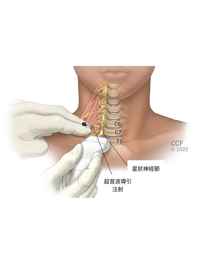 星狀神經節注射 星狀神經節注射