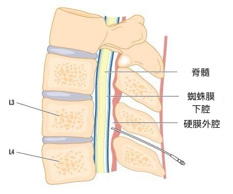 硬膜外注射