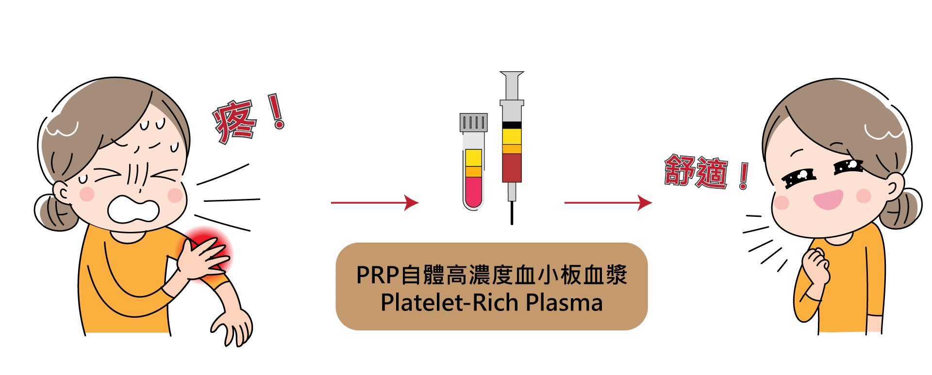 PRP注射