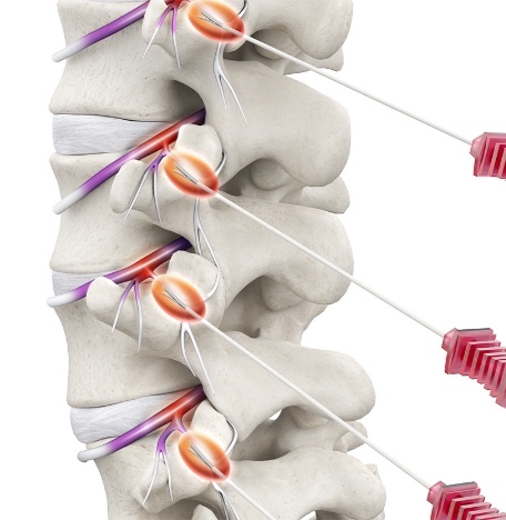 高頻熱凝療法（Radiofrequency Ablation, RFA）