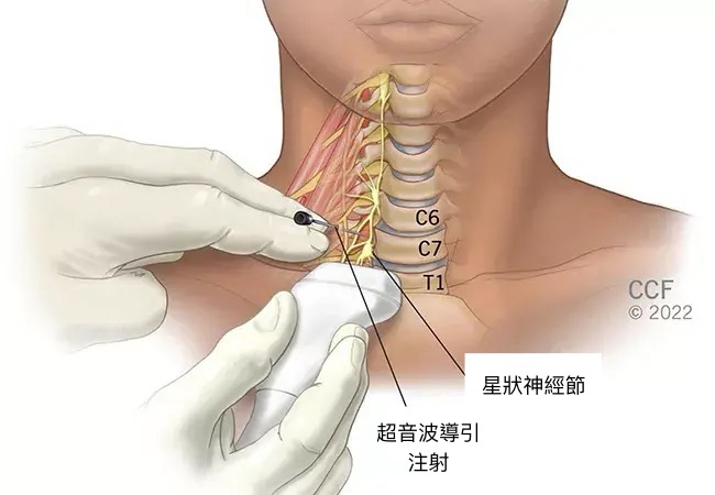 星狀神經節阻斷術,SGB