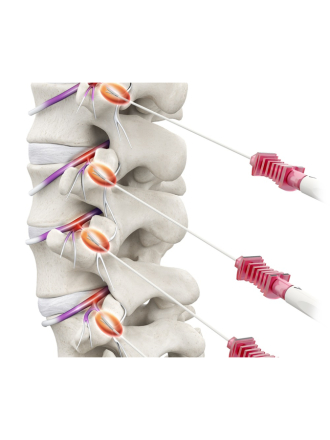 高頻熱凝療法（Radiofrequency Ablation, RFA）